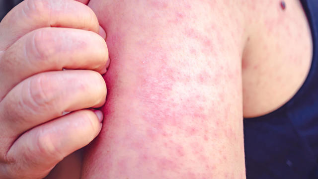 Measles cases rose 79% globally last year, WHO says. Experts explain why.