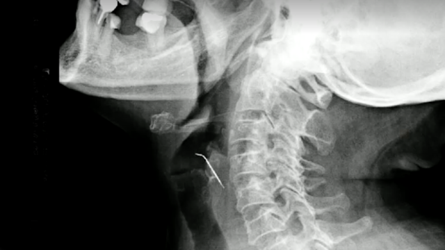 A woman went to the ER thinking she had a bone stuck in her throat. It was a nail piercing her artery.